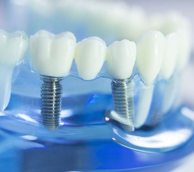 El Cajon Dental Implants