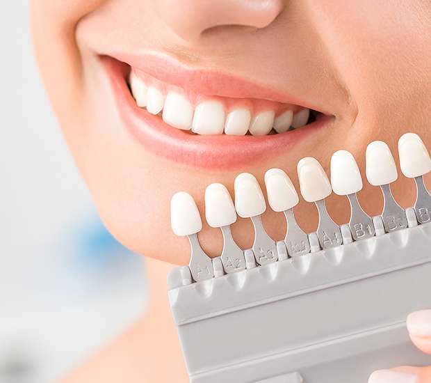 El Cajon Dental Veneers and Dental Laminates