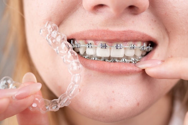 Why Do I Need Spacers In My Orthodontics Treatment?