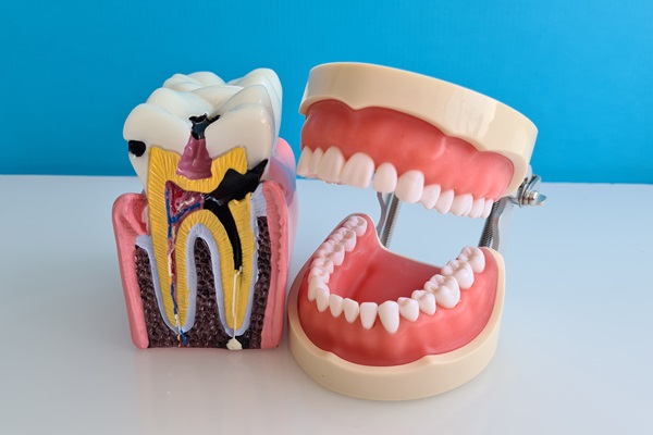 Signs You May Need A Root Canal: When To See A Dentist